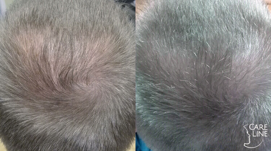 Karboksyterapia Criss Carbo-Oxyna wypadające włosy